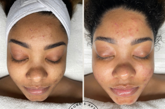 Acne D-Tox