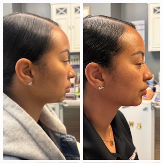 Facial Balancing Before & After Result