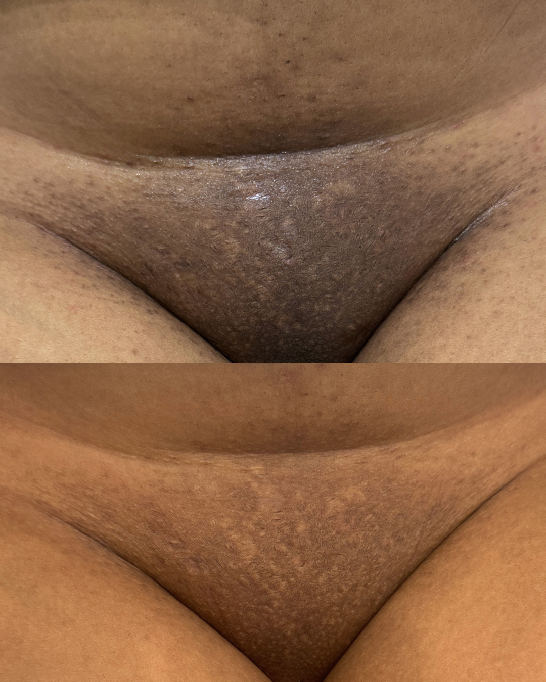 Before and after — intimate area