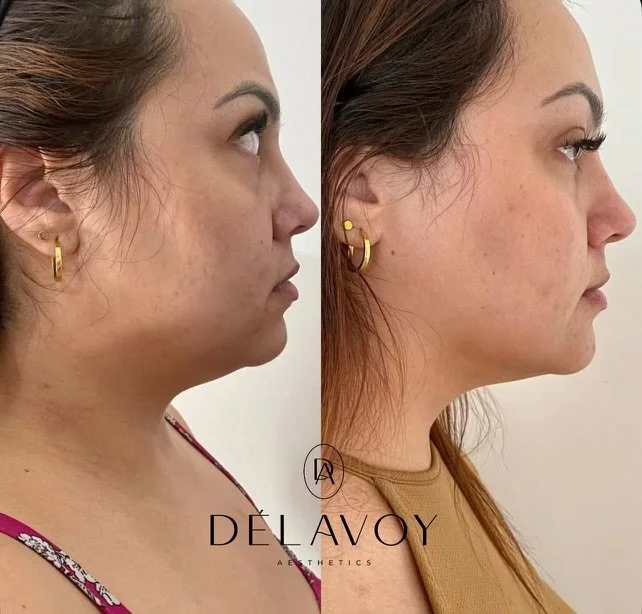 Before treatment, woman side profile with fuller jawline