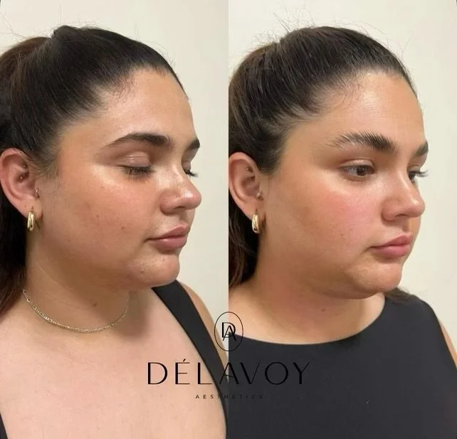 Before treatment, woman side profile with fuller jawline