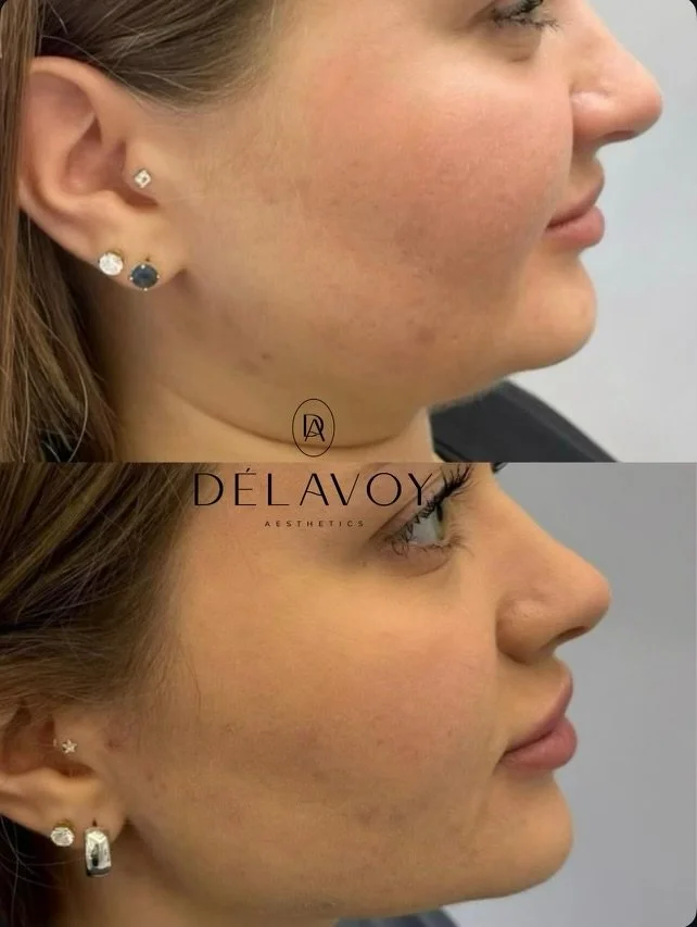 After treatment, woman side profile with contoured jawline