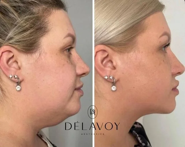 After treatment, woman side profile with slimmer jawline