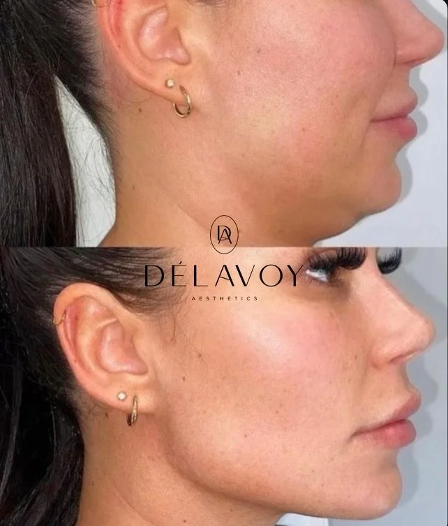 Before treatment, woman side profile with less defined jawline