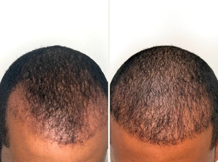 Before-and-after top-of-scalp photos from a Jlyss hair restoration client