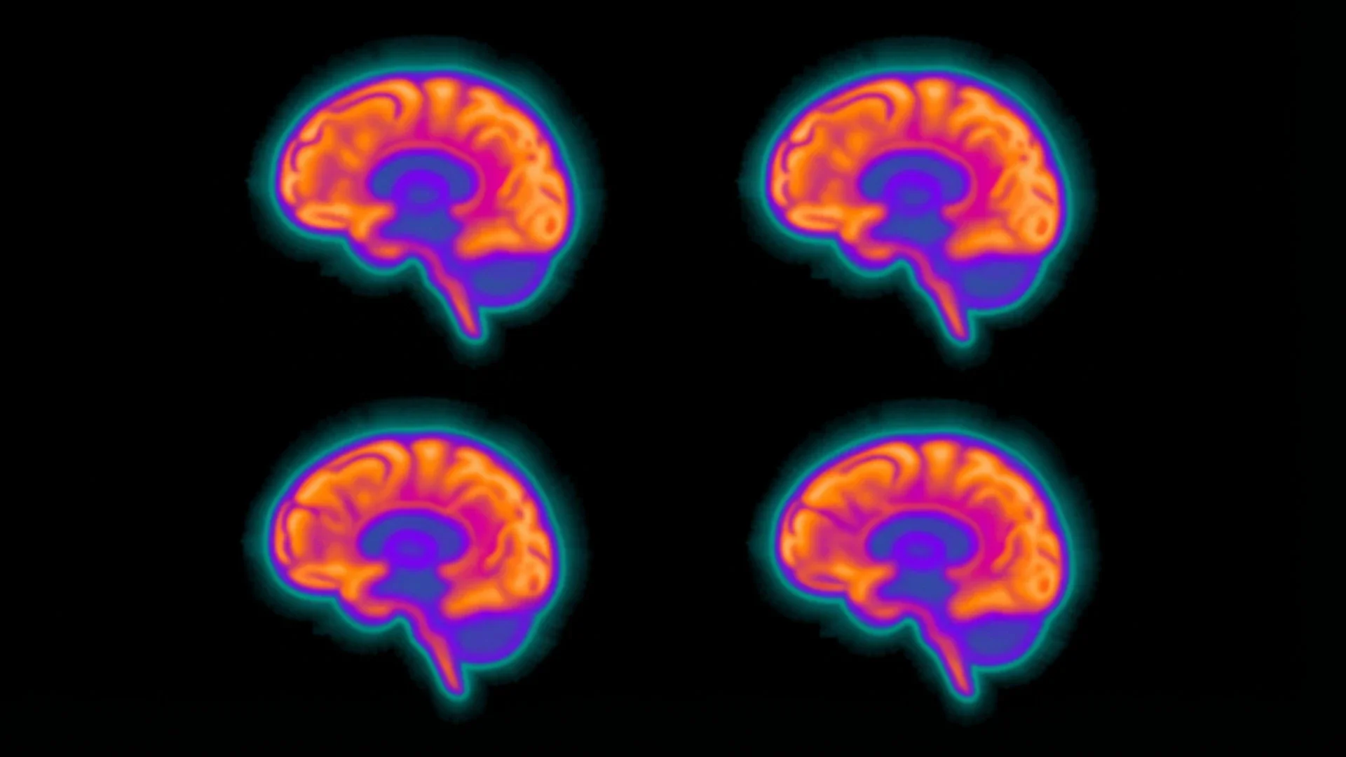 
Four colorful side-view brain scans on a black background, illustrating brain imaging often associated with ADHD diagnosis