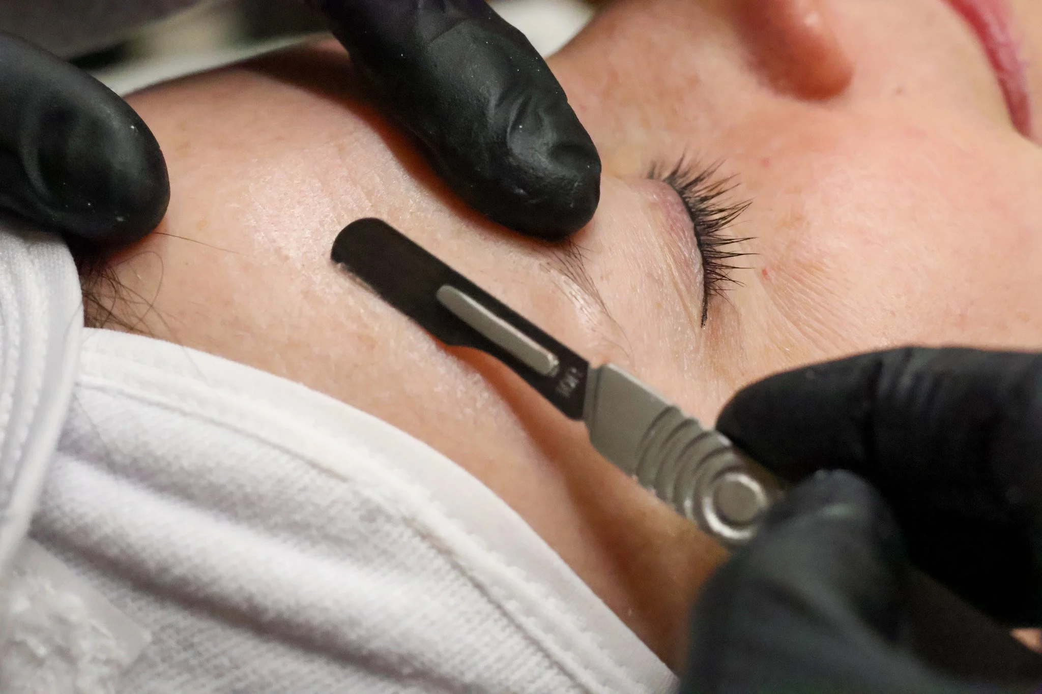 Dermaplaning treatment
