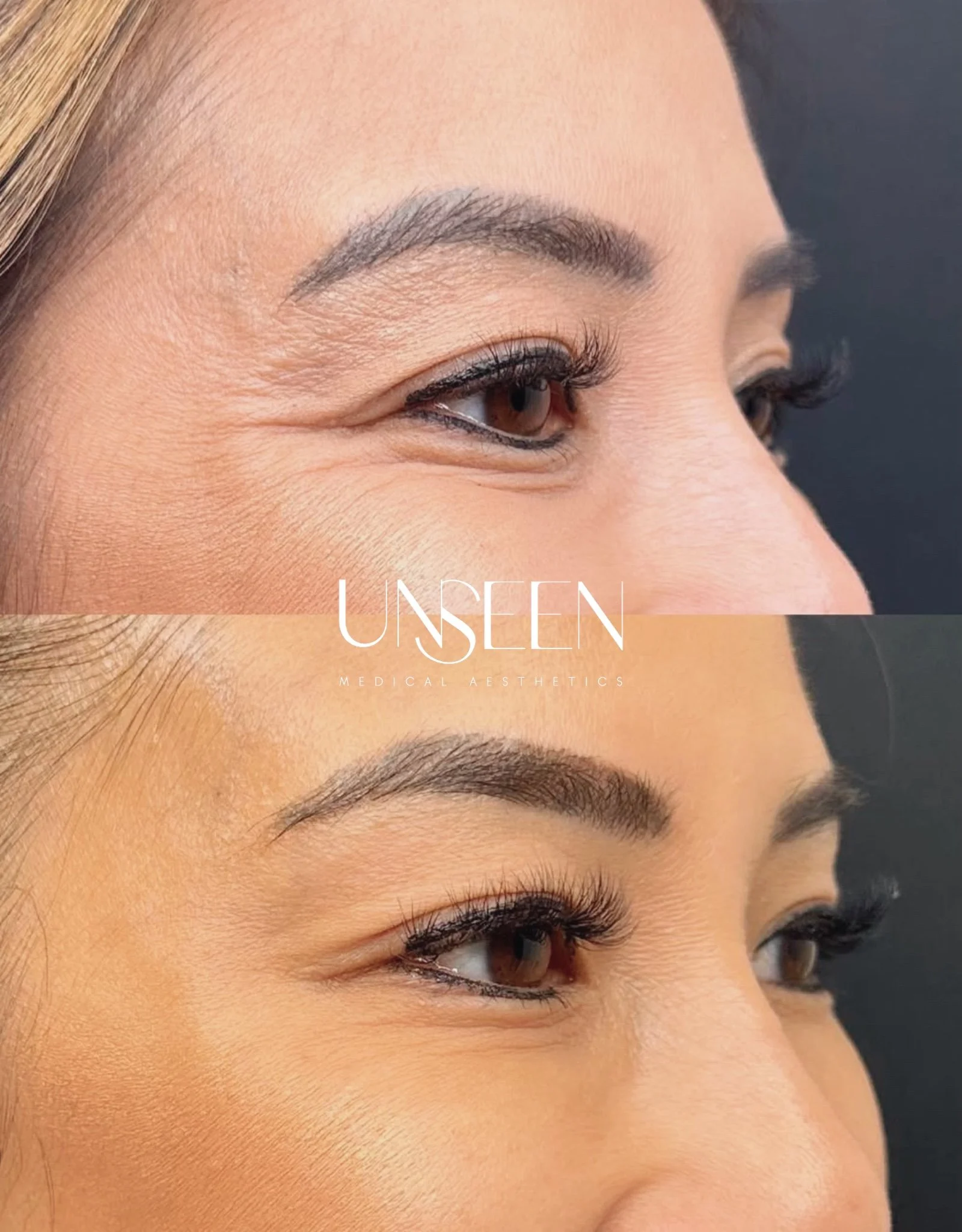 Crow's feet before and after