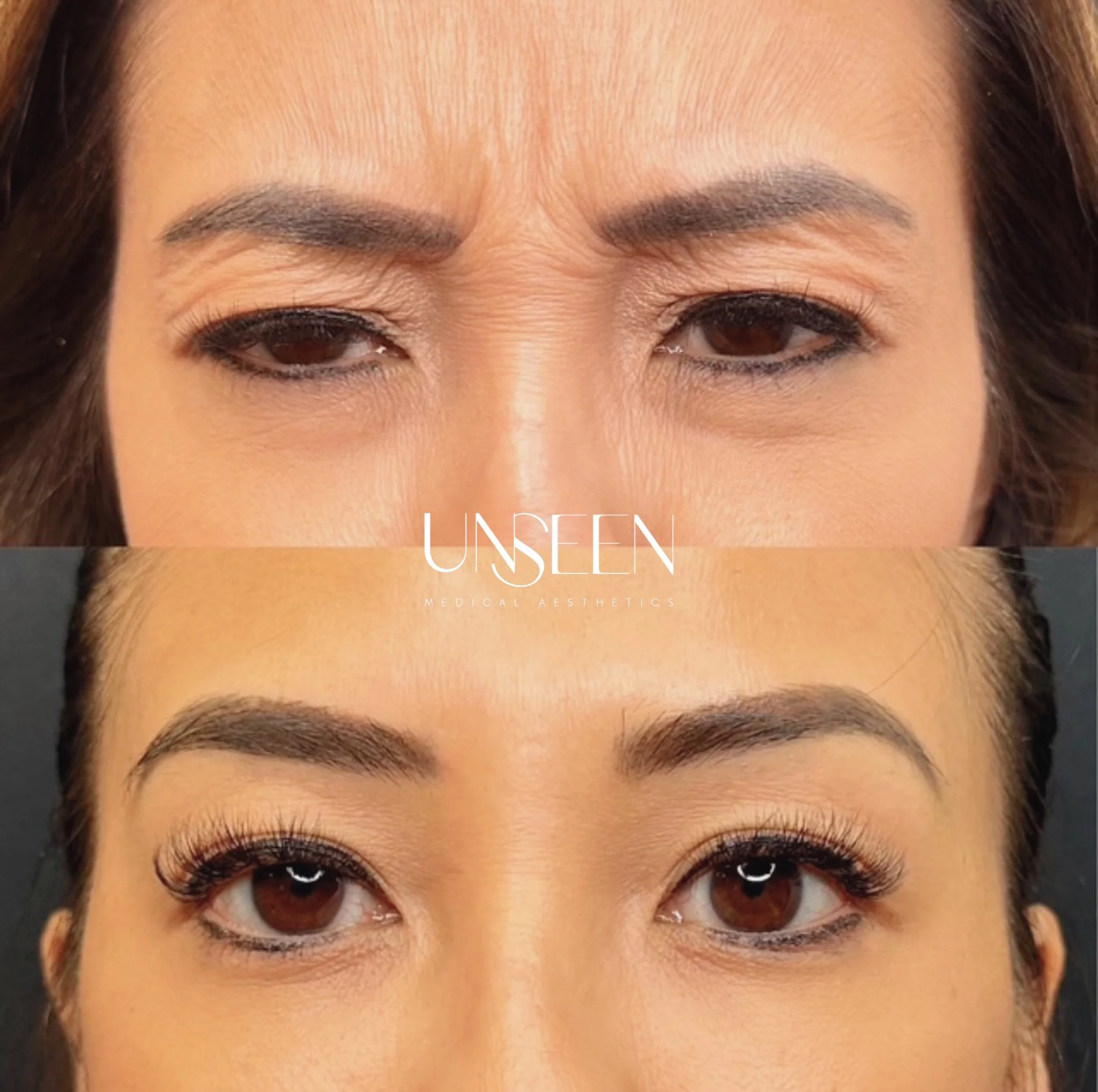 Frown lines before and after