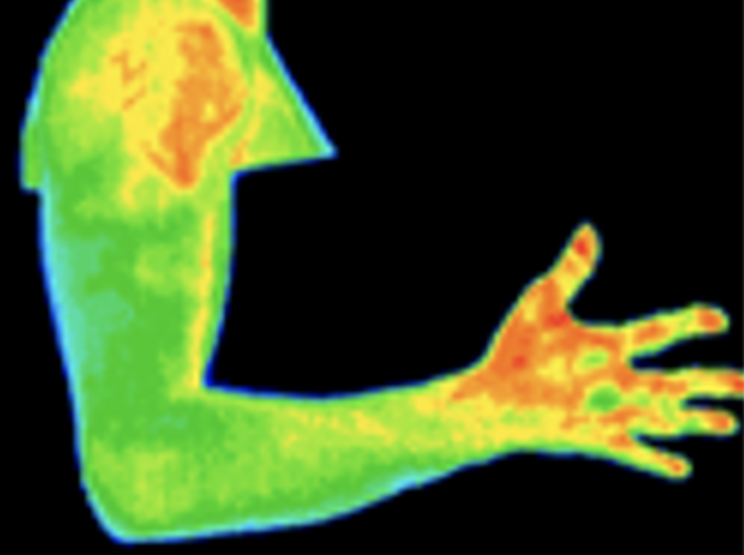 Thermography image of arm