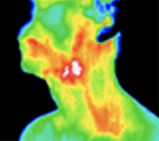 Thermography image of carotid artery