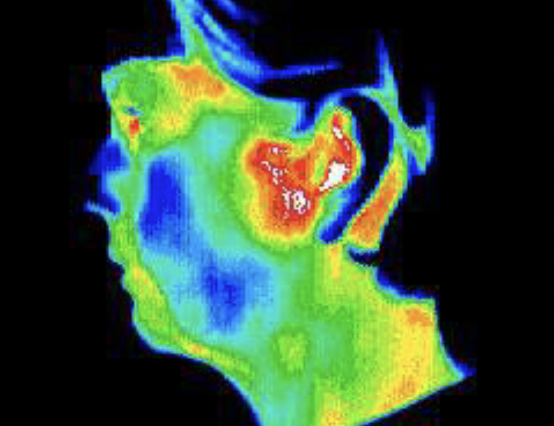 Thermography scan of TMJ and jaw area