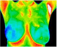 Breast thermography scan showing heat patterns