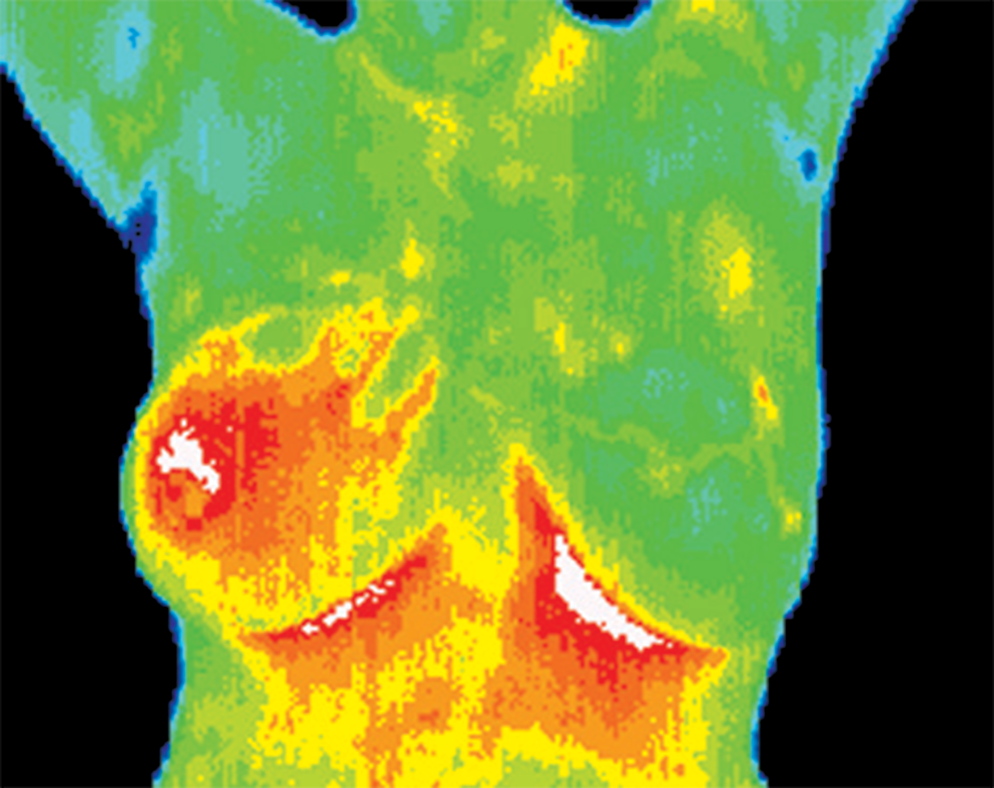Inflammatory Cancer