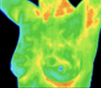 Thermography image of breast, lateral view