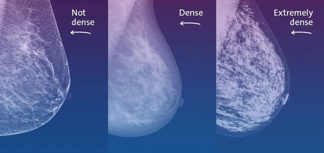Dense breasts illustration