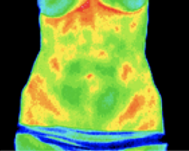 Thermography scan of abdomen area