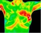 Thermography scan of breast area