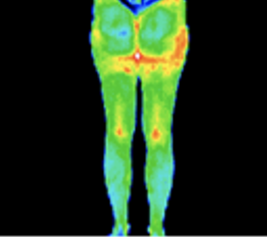 Thermography image of buttocks