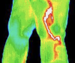 Thermography scan showing vascular activity