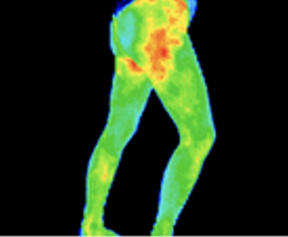 Thermography image of hip