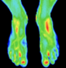Thermography image of feet