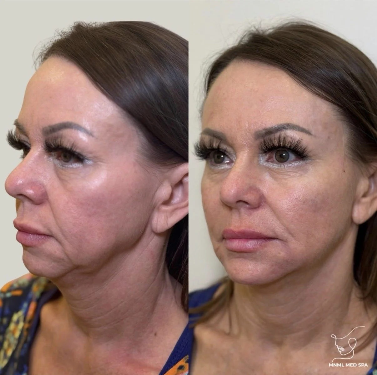 Christina treatment before-and-after comparison