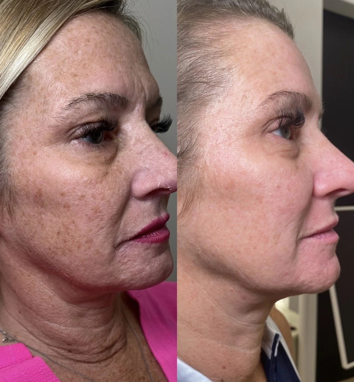 Maddox treatment before-and-after comparison