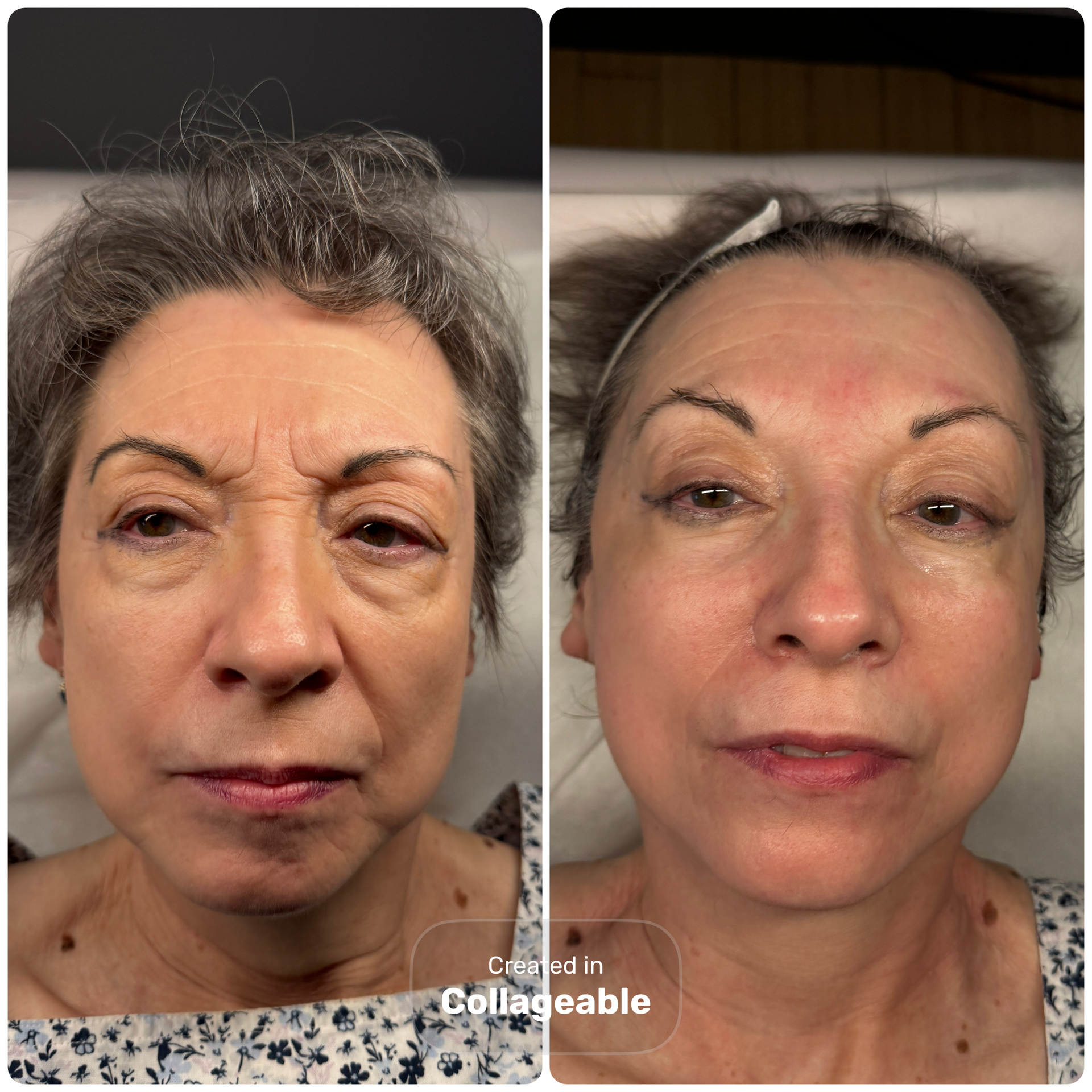 Natural Facelift before and after results showing smoother, more radiant skin