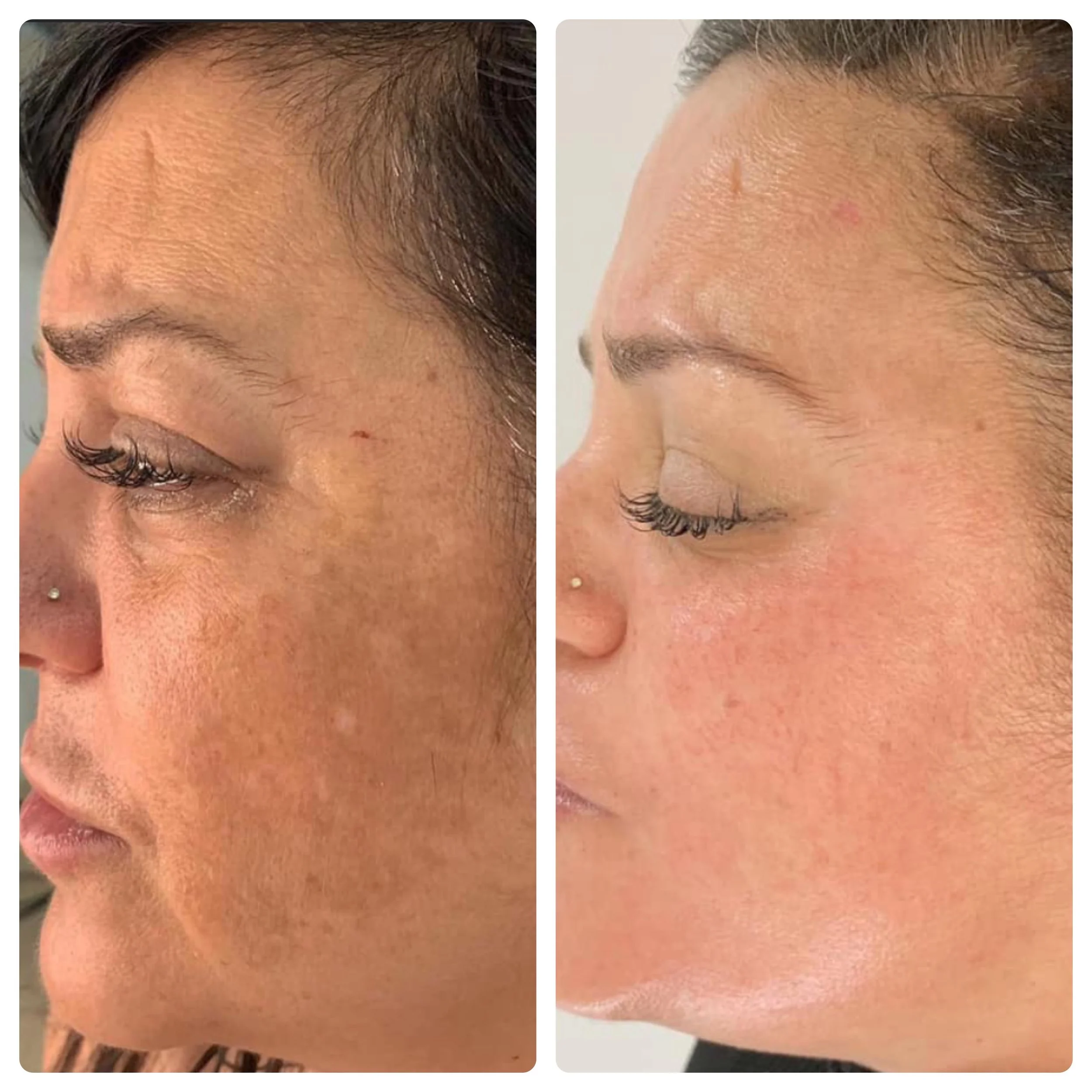 Glo2 Facial before and after results showing revitalized, glowing complexion
