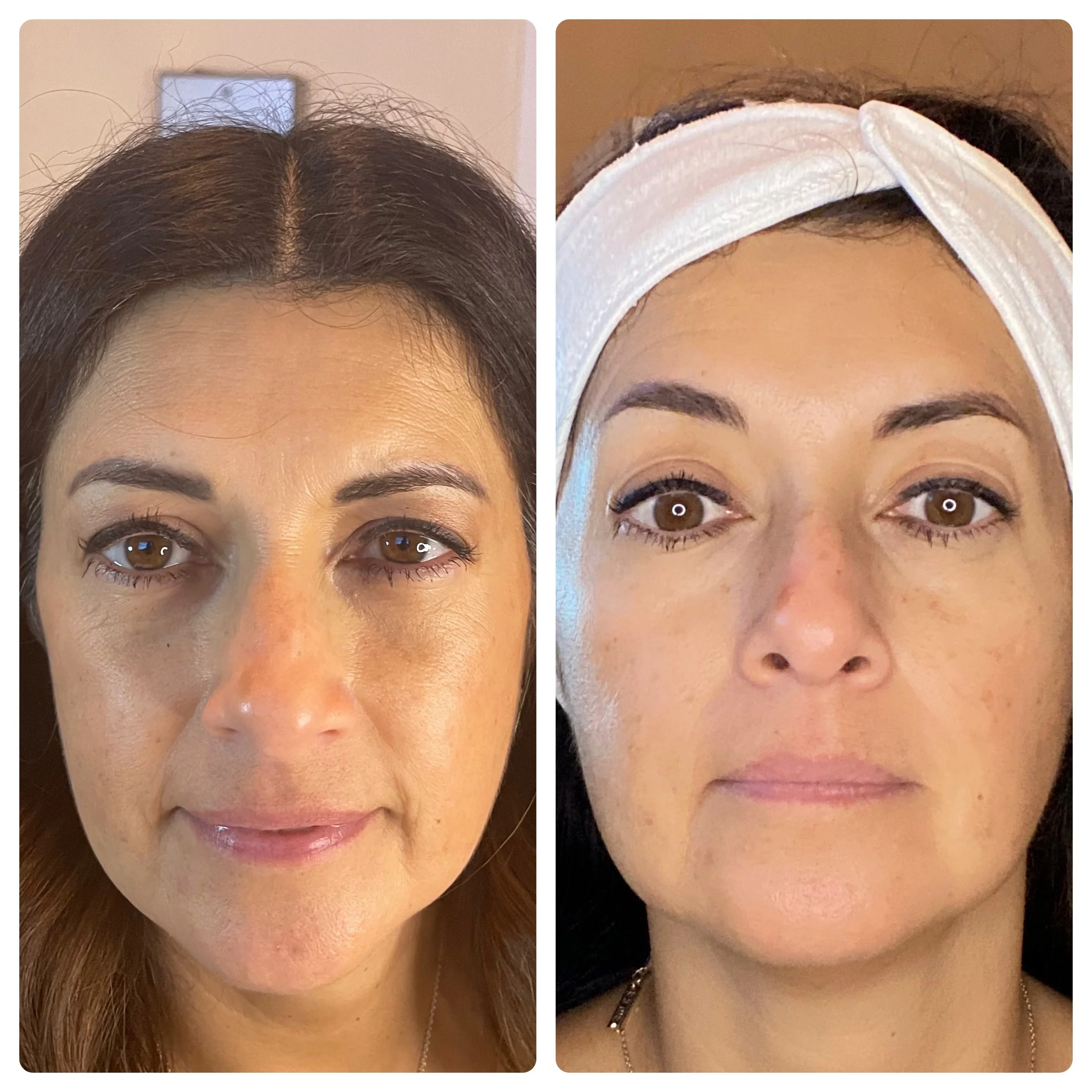 Quick Lifting Facial before and after results showing tighter, lifted appearance