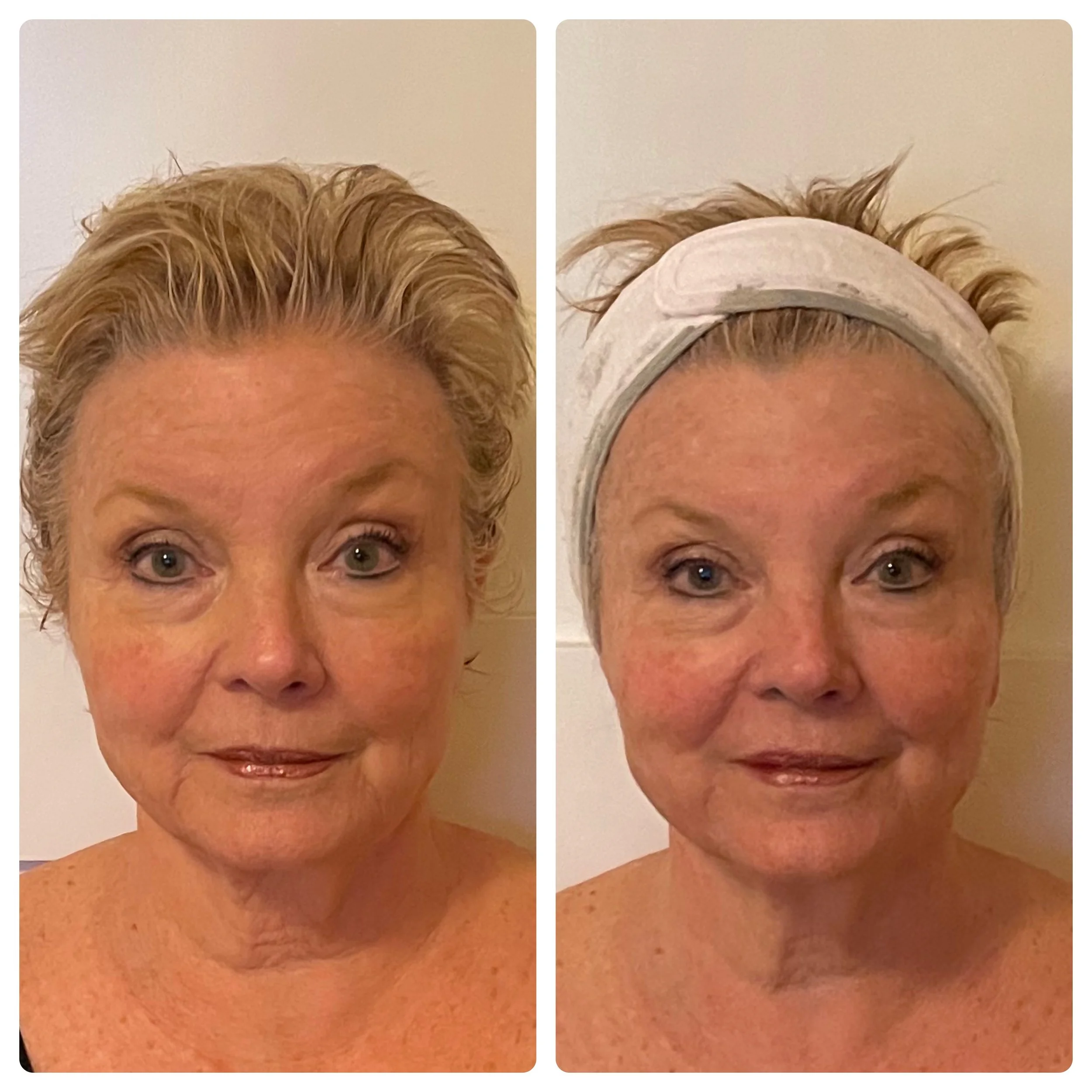 Natural Facelift before and after results showing lifted, rejuvenated appearance