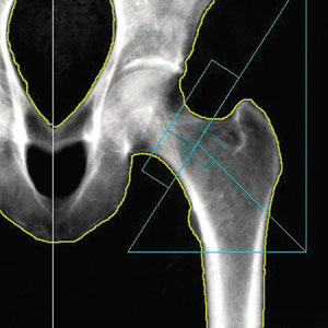 DEXA bone density scan image of the hip