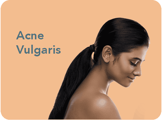 Acne Vulgaris