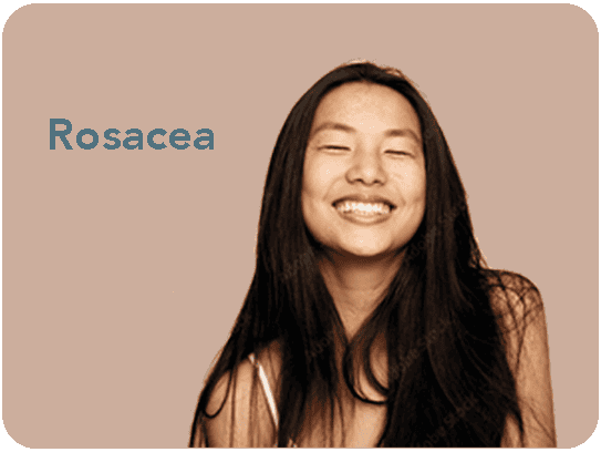 Rosacea