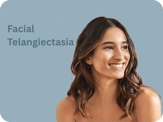 Facial Telangiectasia