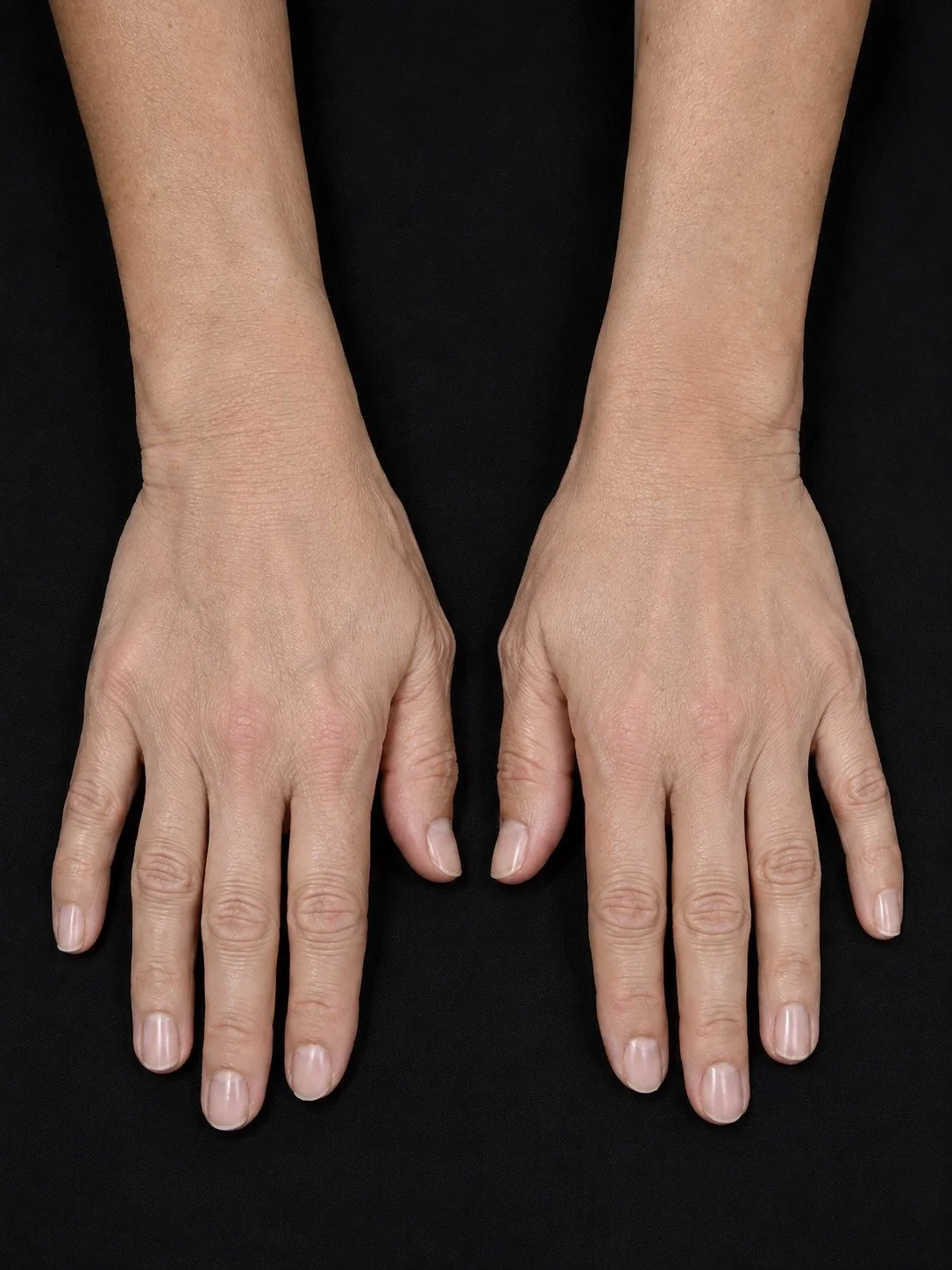 After hand rejuvenation treatment