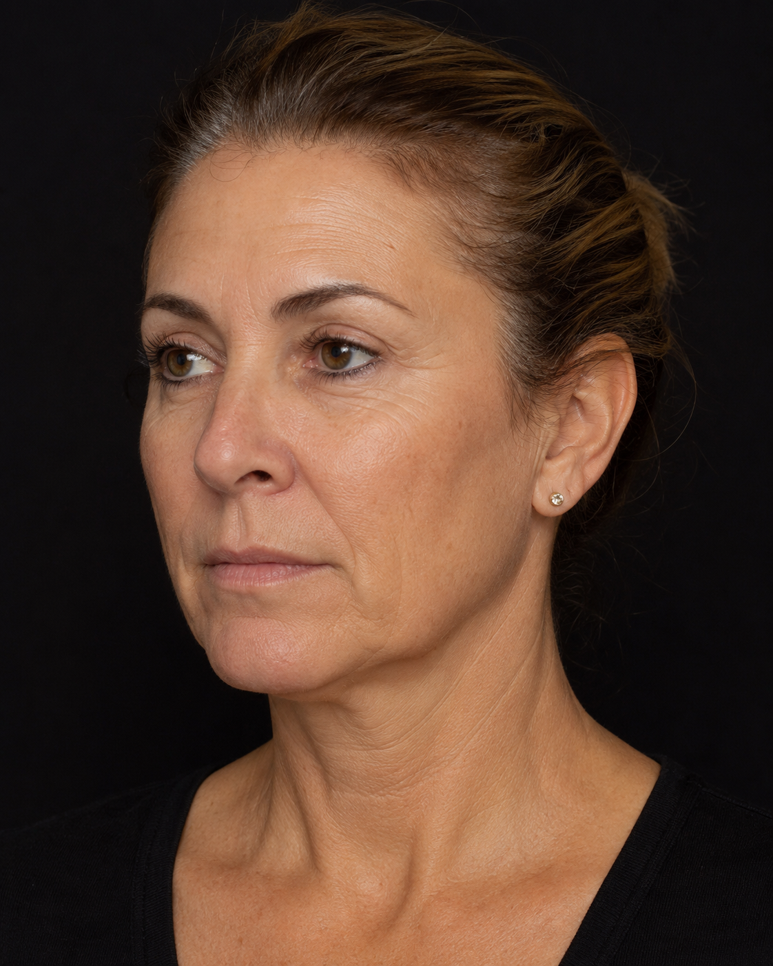 Before facial biostimulation treatment