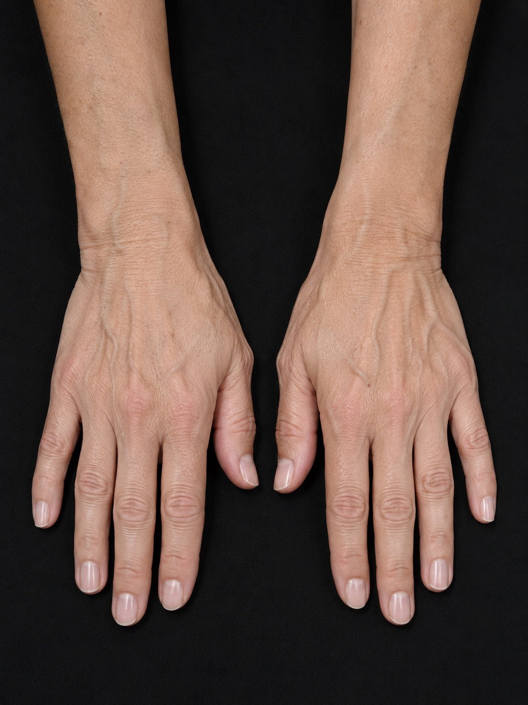 Before hand rejuvenation treatment