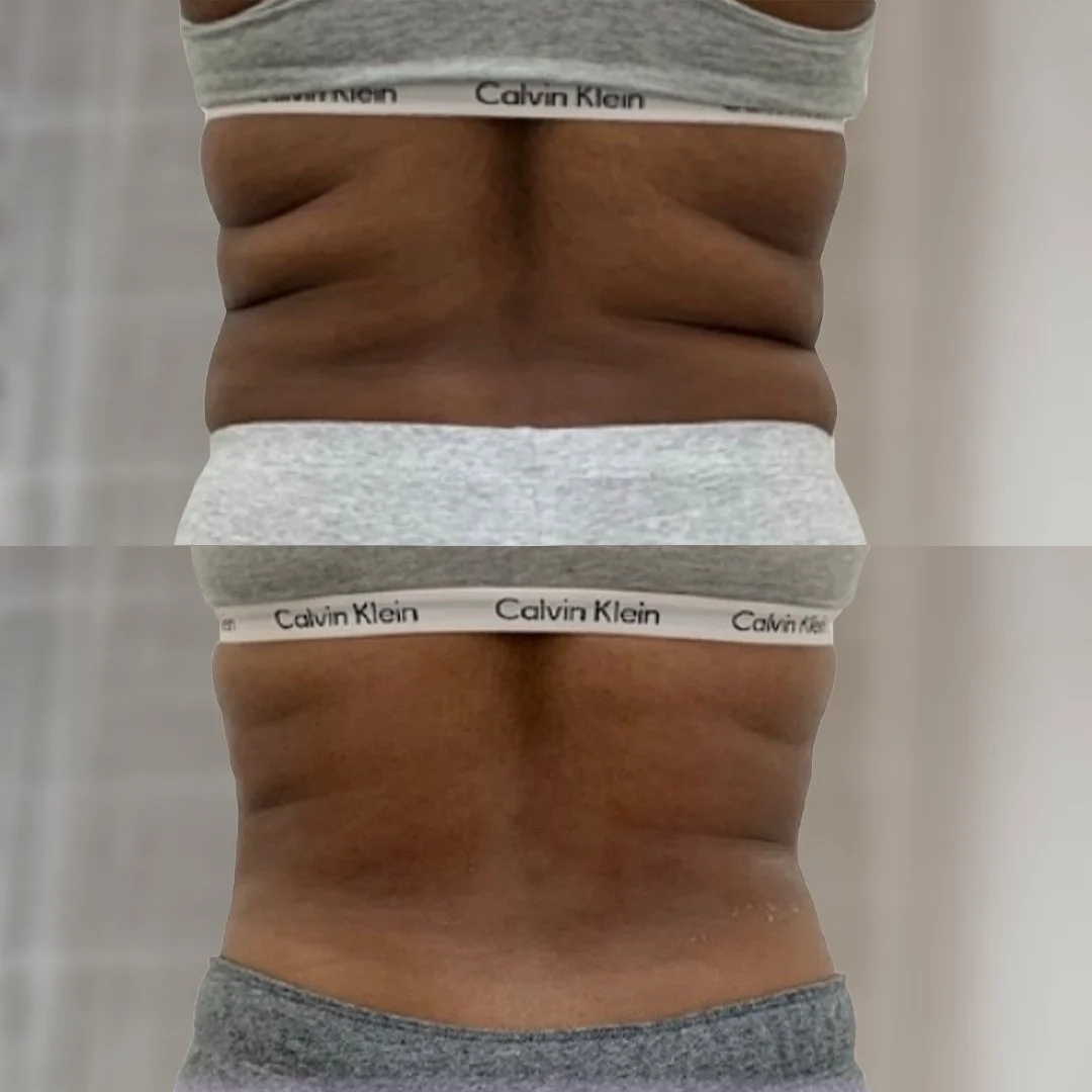 Back and Bra Roll Reduction before on top and after 3 treatments below