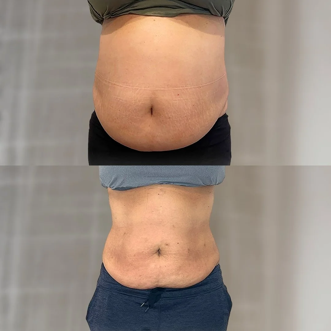 Noninvasive Tummy Tuck before on top and after 8 treatments below