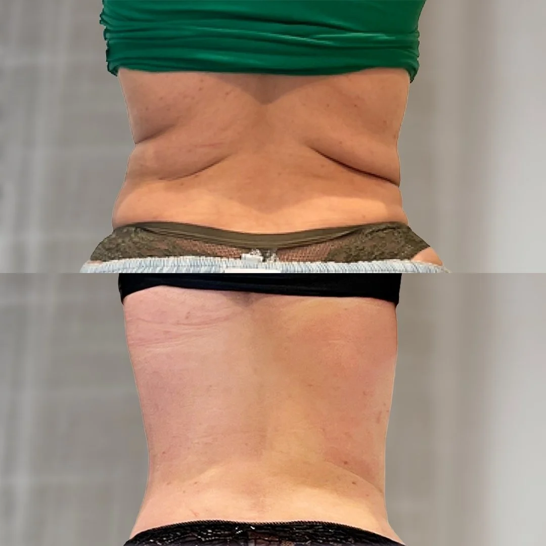 Back and Bra Roll Reduction before and after 3 treatments, before on top and after below