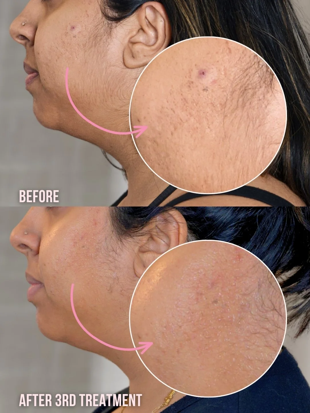 Jet Plasma before on top and after 3 treatments below