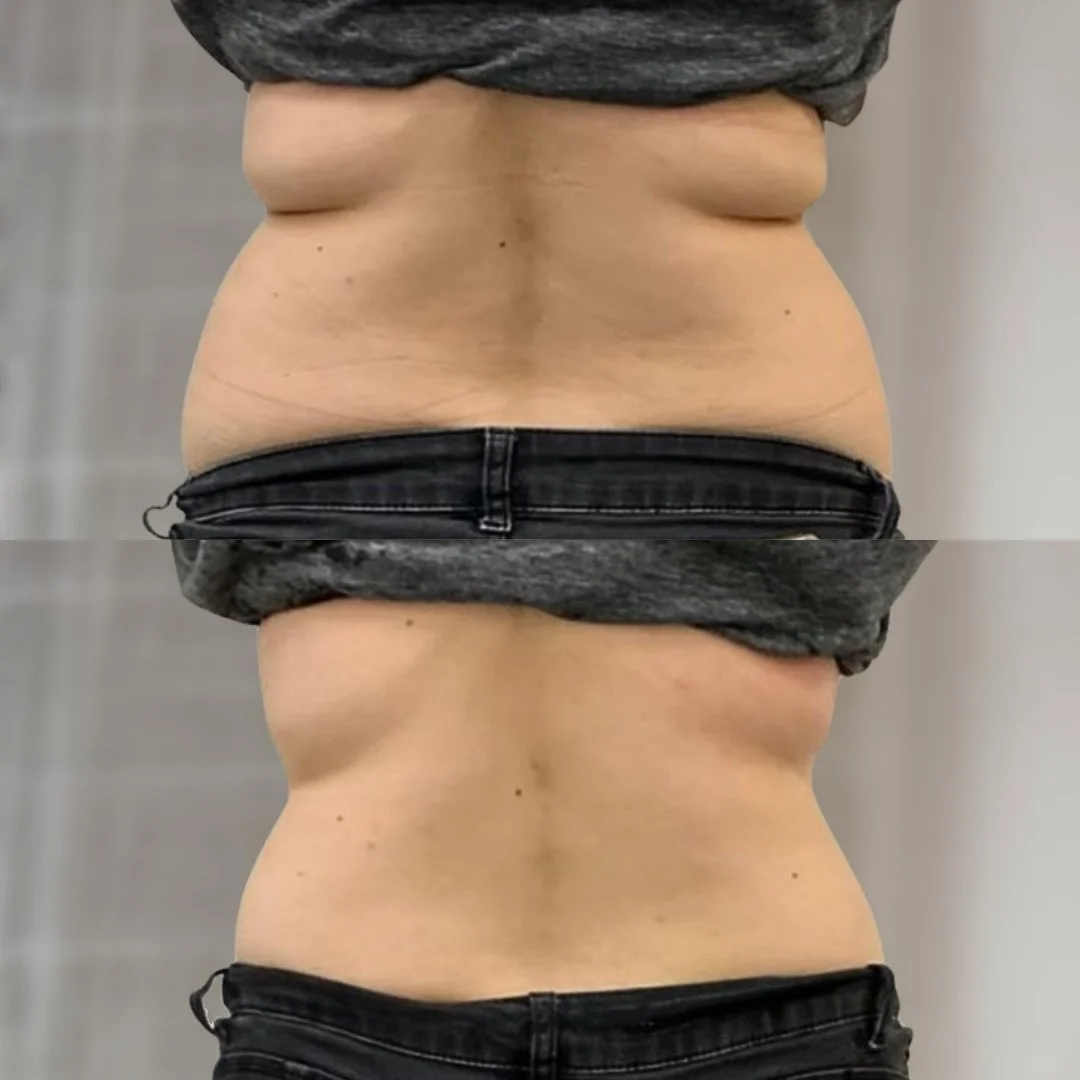 Back before on top and after 3 treatments below