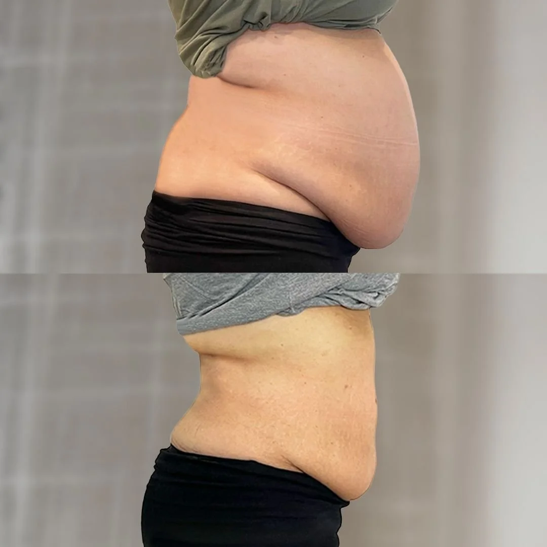 Noninvasive Tummy Tuck before and after 8 treatments, side view