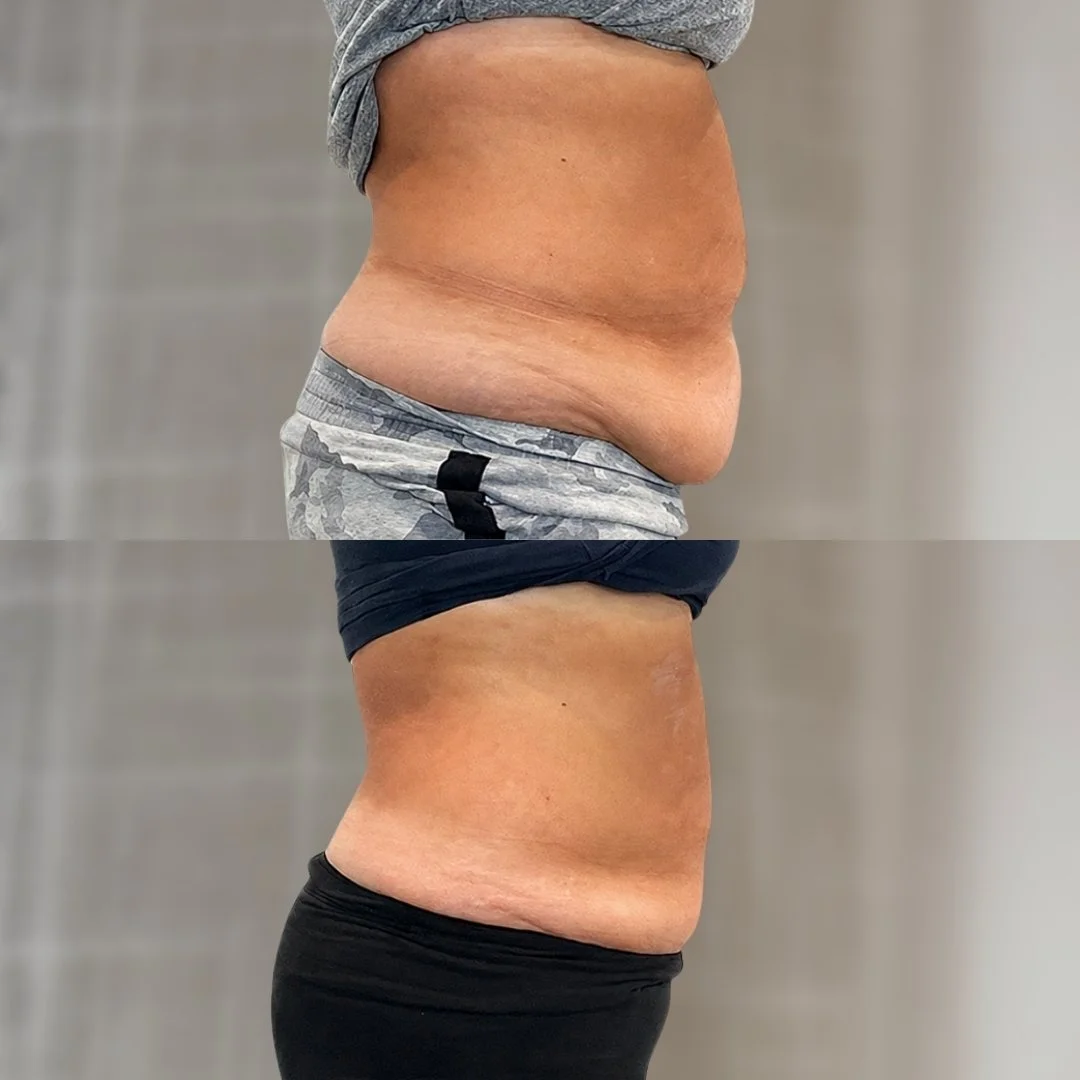 Noninvasive Tummy Tuck before on top and after 3 treatments below
