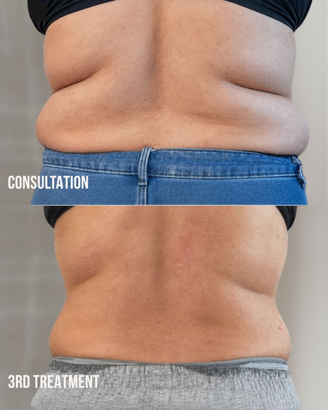 Back and Bra Roll Reduction client before consultation and after the third treatment