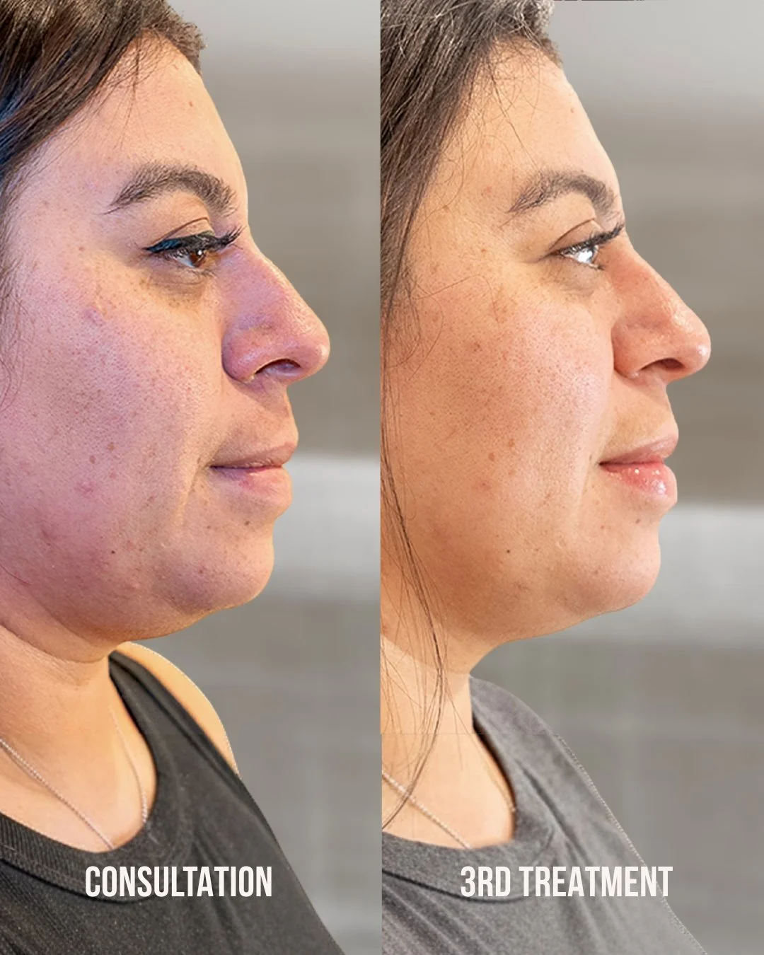Jet Plasma Facelift client before consultation and after the third treatment
