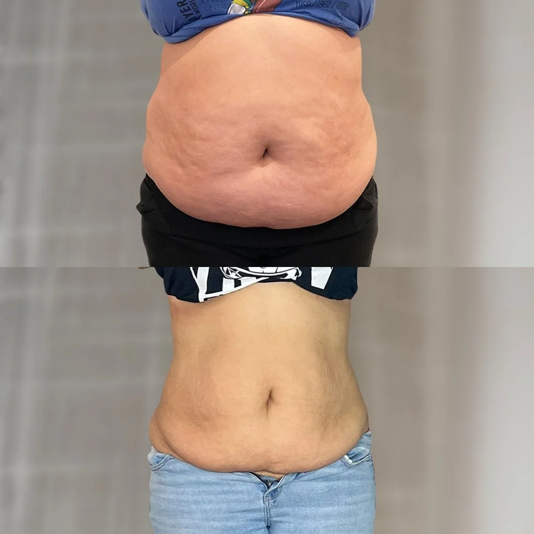 Tummy before on top and after 5 treatments below