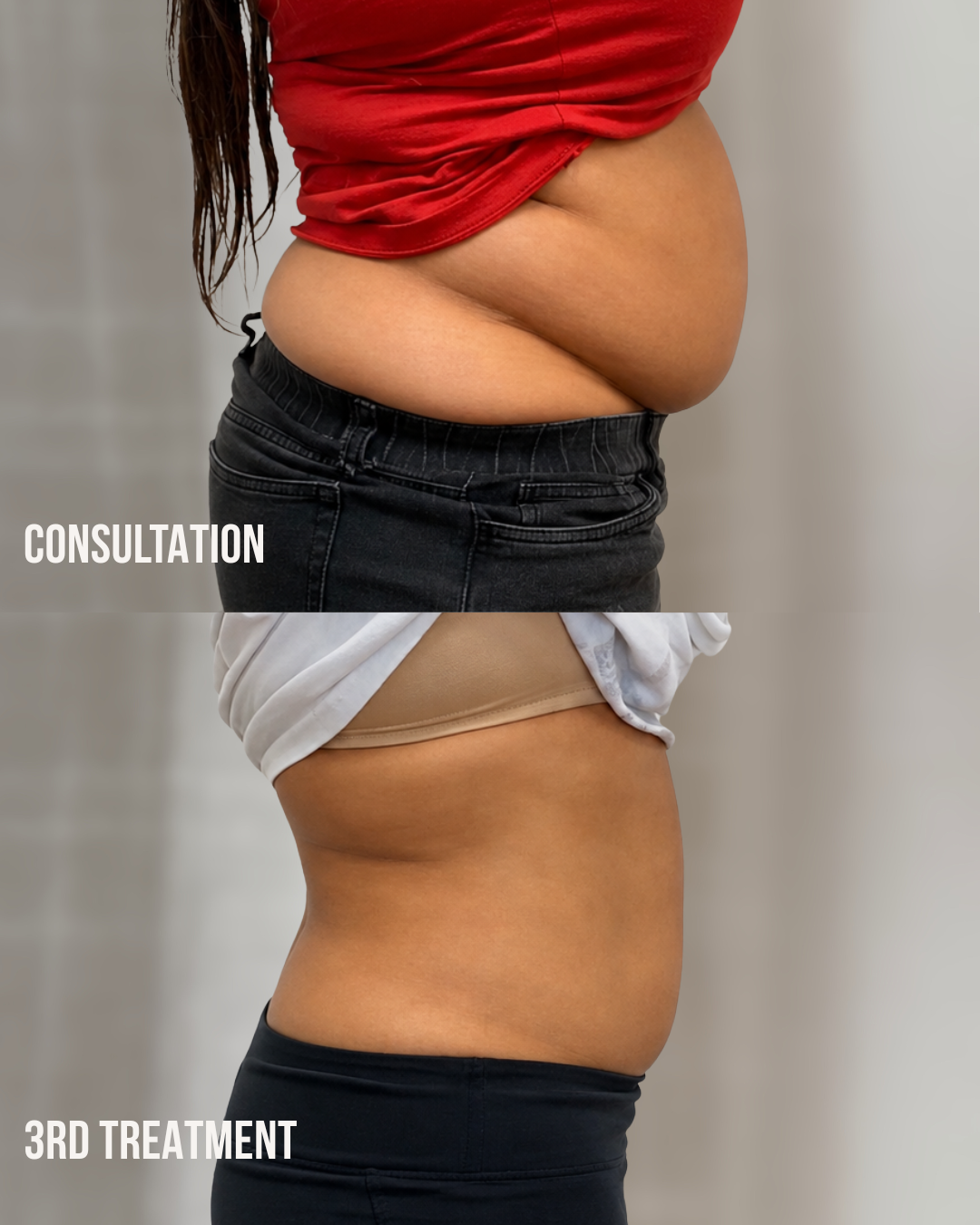 Noninvasive Tummy Tuck client before consultation and after the third treatment